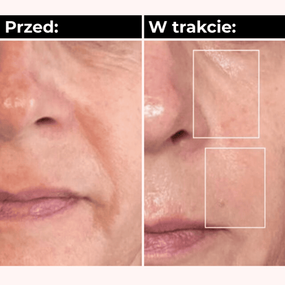 SkinGlow™ LED Mask