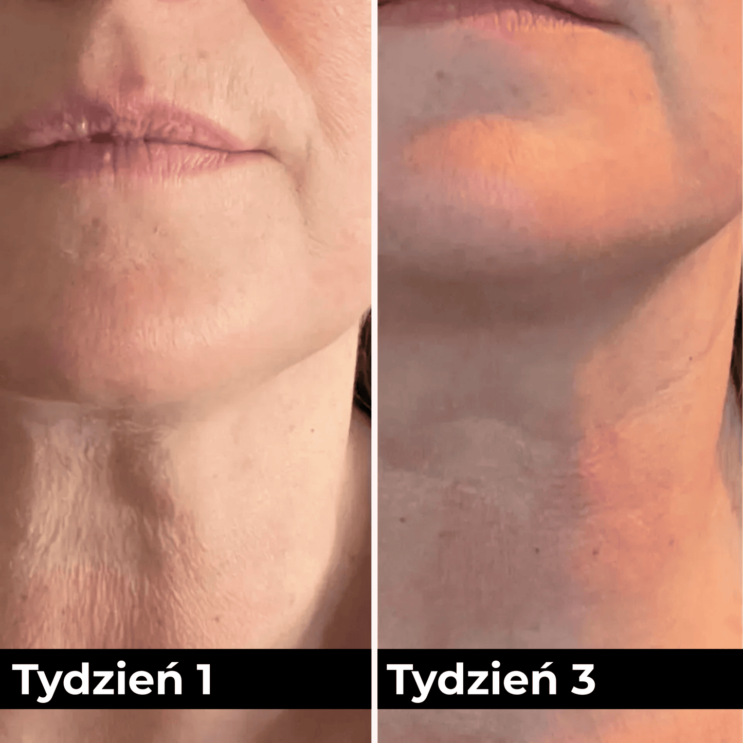 SkinGlow™ LED Mask