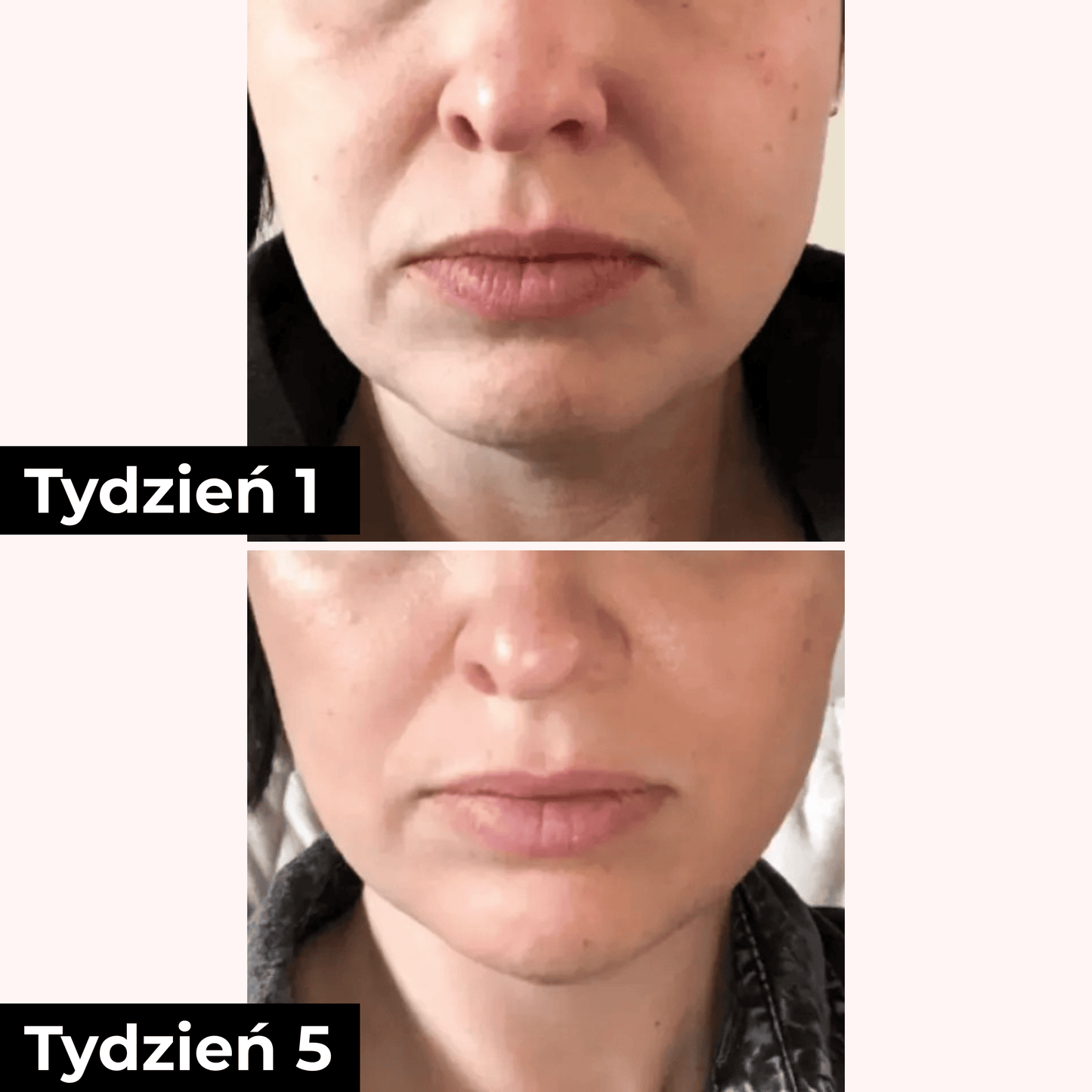 SkinGlow™ LED Mask